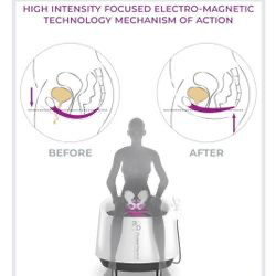 powerform-v treatment